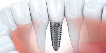 A digital image of a dental implant sitting between two healthy teeth along the lower arch in Phillipsburg