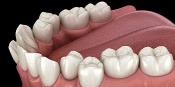 Illustration of crooked teeth