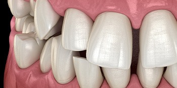 Illustration of gapped teeth