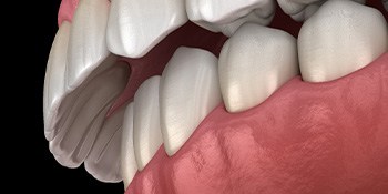 Illustration of an overbite