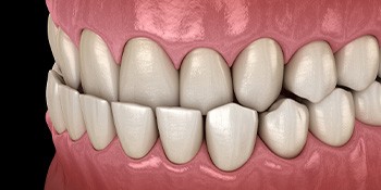Illustration of an underbite