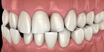 Illustration of a crossbite