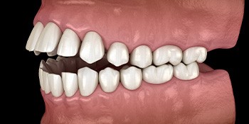 Illustration of a crossbite