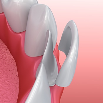 Animation of porcelain veneer placement