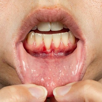 Closeup of patient with receding gums