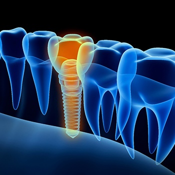 X-ray diagram representing laser-assisted dental implant placement in Phillipsburg