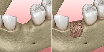Before and after diagram of bone grafting in Lehigh Valley