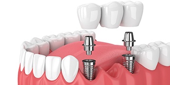 Diagram of implant bridge replacing multiple missing teeth in Phillipsburg