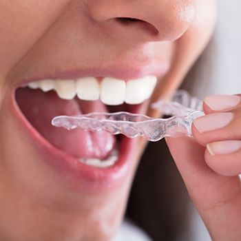 Invisalign Phillipsburg, NJ, Clear Braces