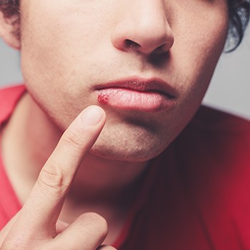 Closeup of canker sore on lip