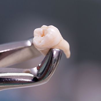 Metal clasp holding extracted tooth