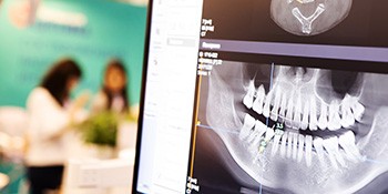 factors that can affect the cost of a root canal include where in the mouth the tooth is located