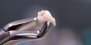 It may be cheaper up front to have a tooth extracted, but the long term costs can often be more expensive than a root canal