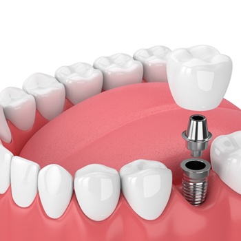 animación de implantes dentales