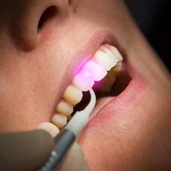tratamiento odontologico laser